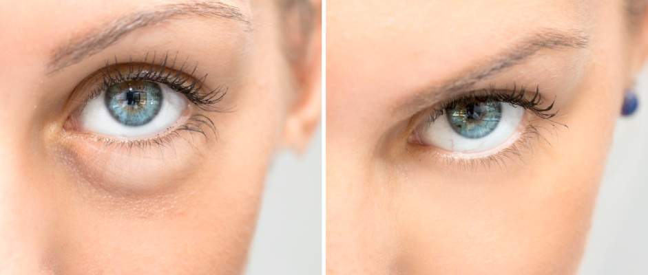 polinucleótidos Madrid Cliniem