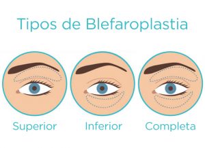Tipos de Blefaroplastia - Blog Cliniem