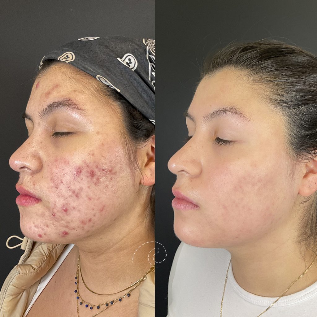 acné Madrid Cliniem