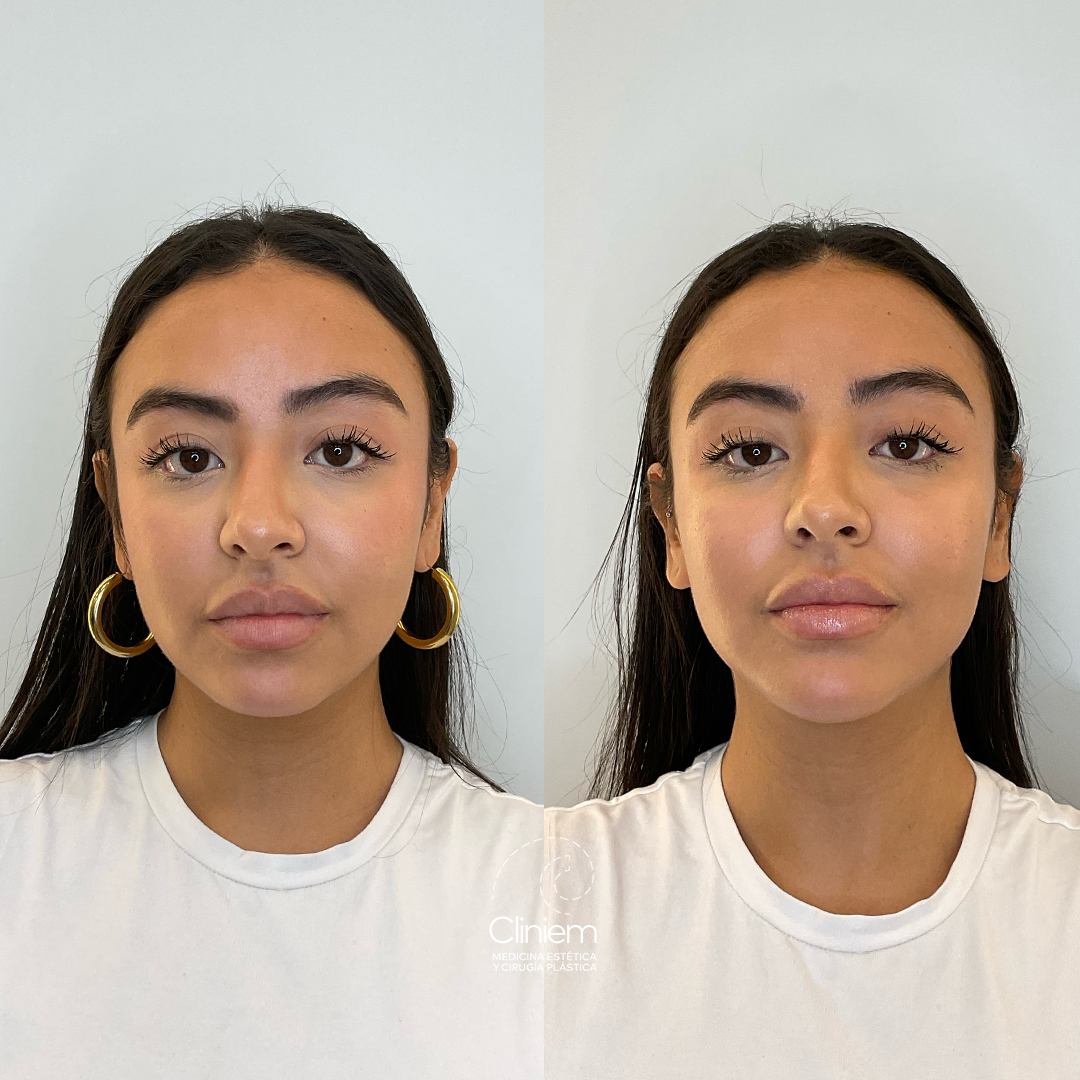 armonización facial y Bótox Madrid Cliniem