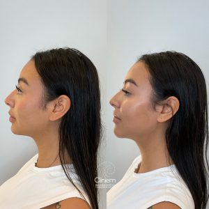 full face Madrid Cliniem