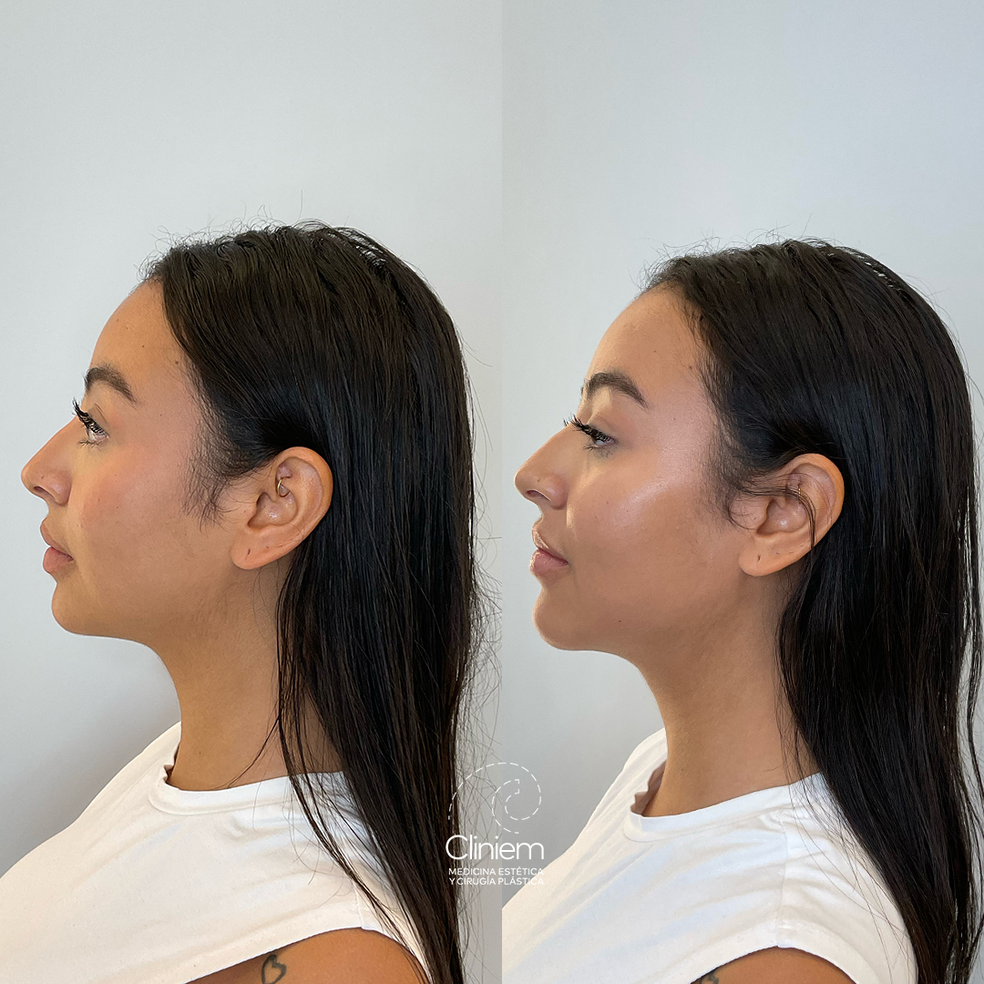 full face Madrid Cliniem