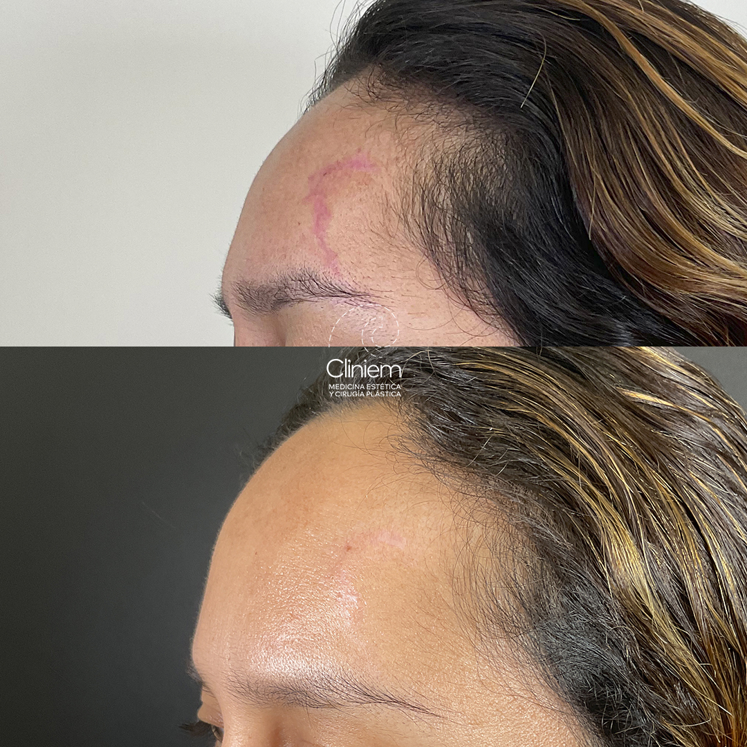 eliminar cicatrices Madrid Cliniem
