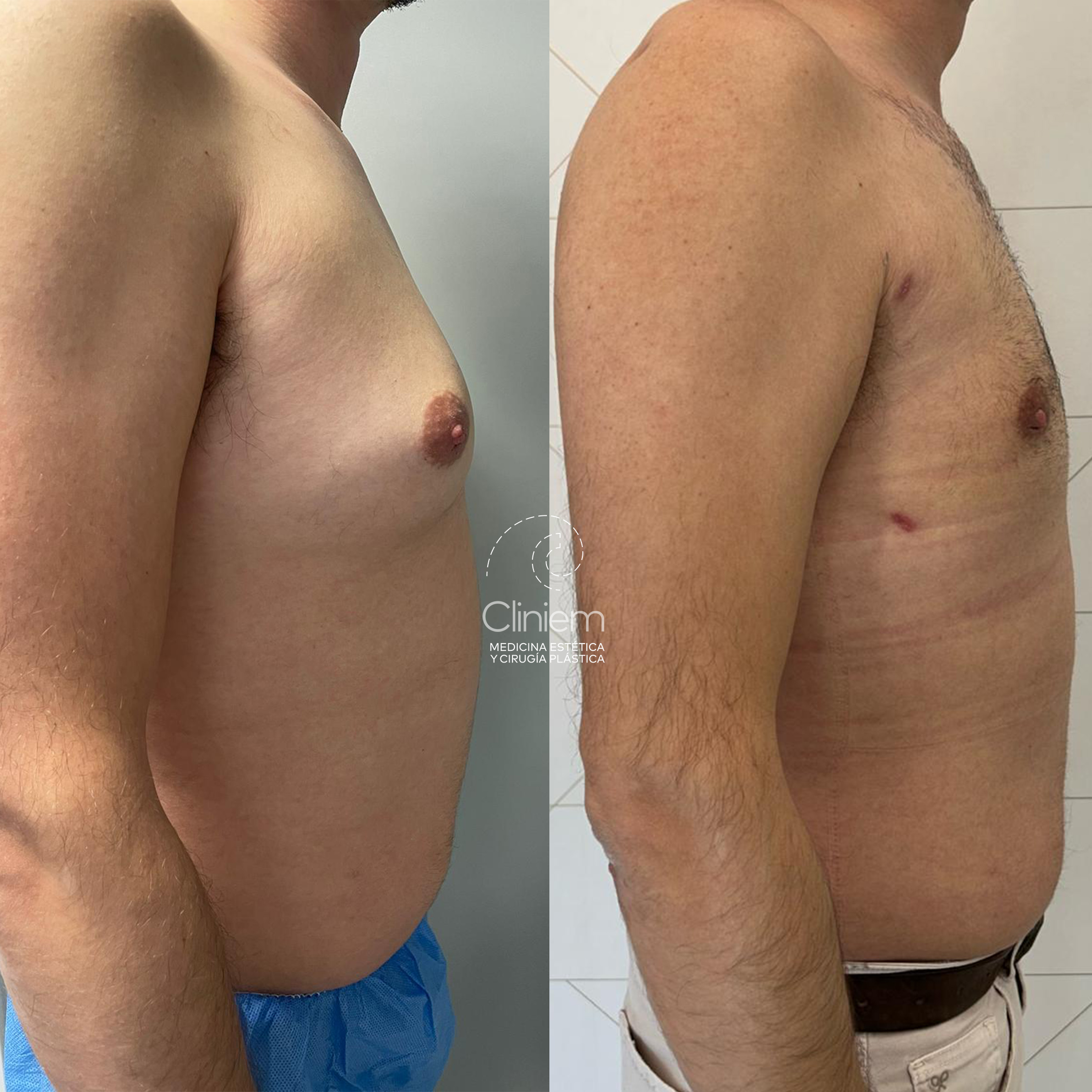 marcación abdominal masculina body tite Madrid Cliniem