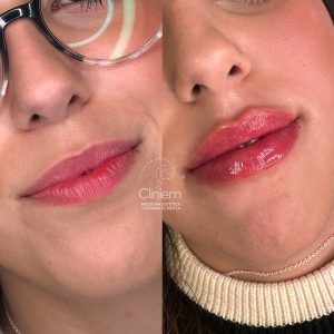 aumento labios Madrid Cliniem