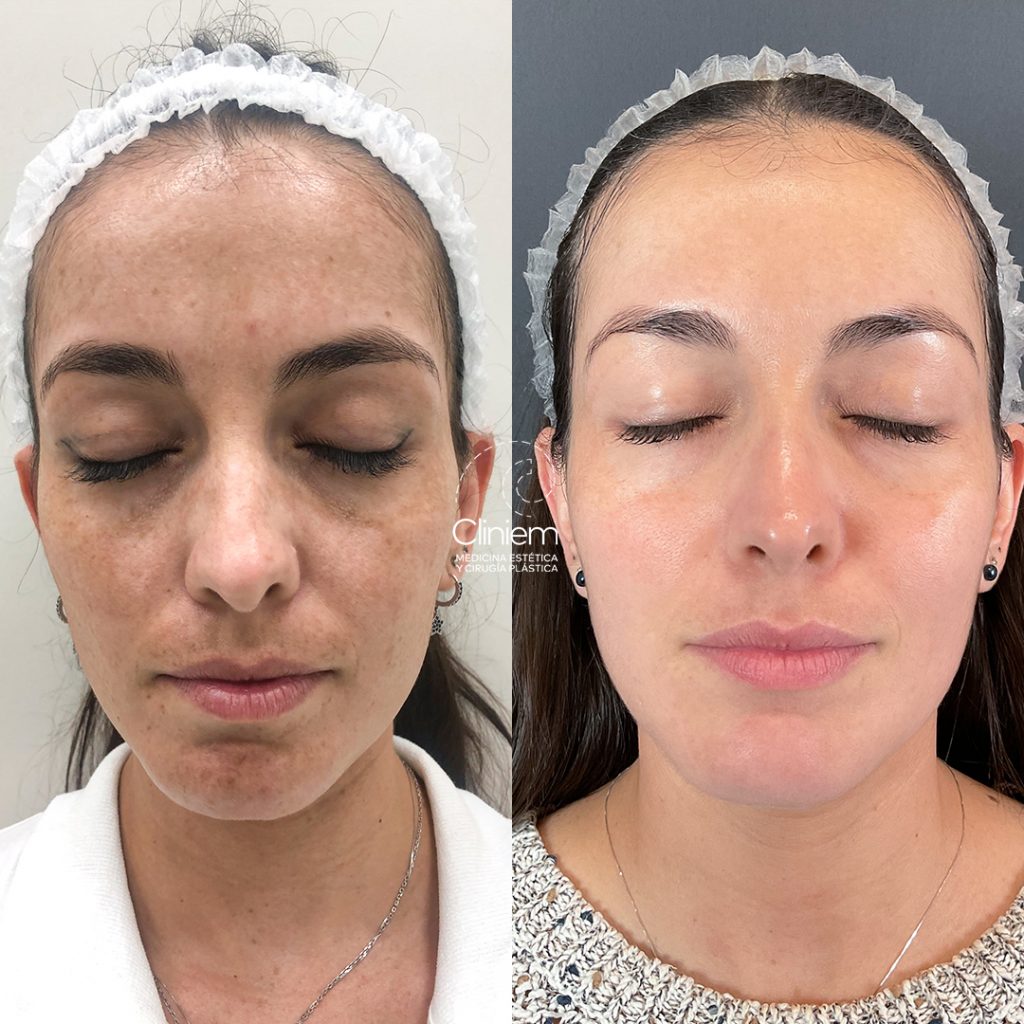 melasma Madrid Cliniem