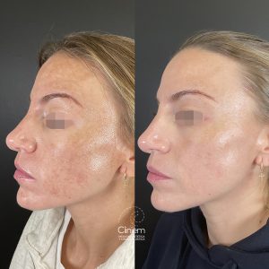 melasma Madrid Cliniem
