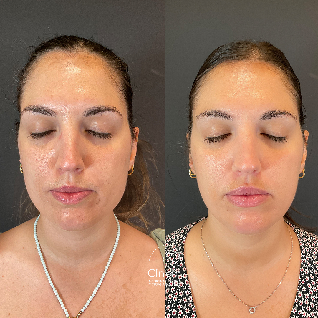 Morpheus o Láser CO₂: Qué tratamiento elegir según tu piel