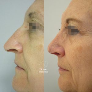 rinoplastia Madrid Cliniem