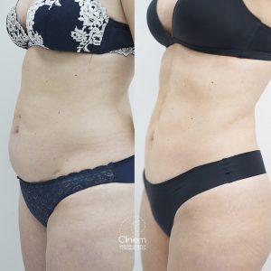 cirugía abdominoplastia Madrid