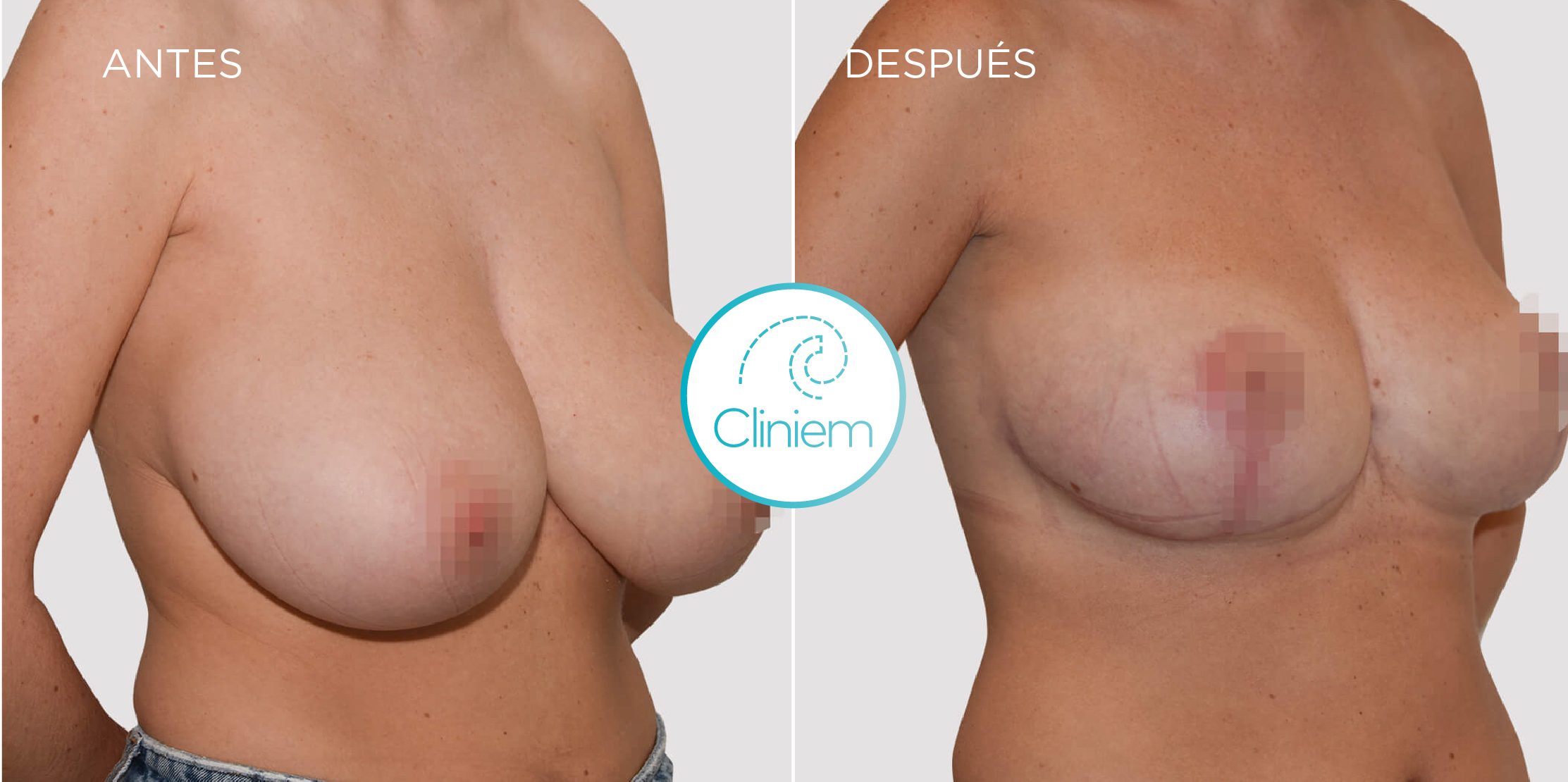 mastopexia Madrid Cliniem