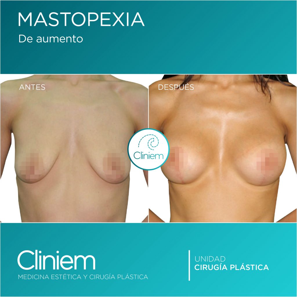 mastopexia Madrid Cliniem