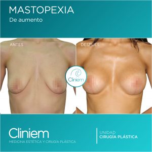mastopexia Madrid Cliniem