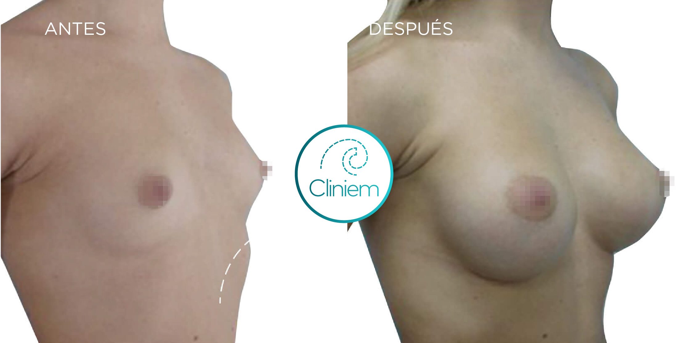 Aumento de pecho sin dolor y con mínimas cicatrices: Preservé, todo lo que necesitas saber