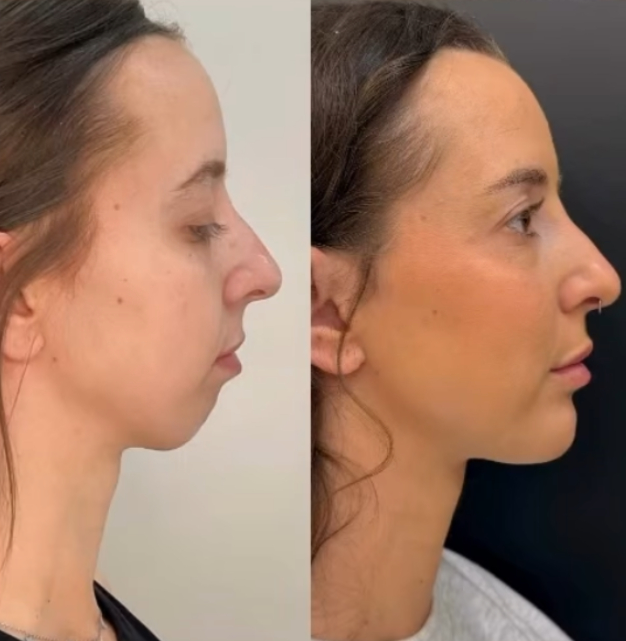 Mentoplastia: Mejora el perfil facial con un pequeño cambio