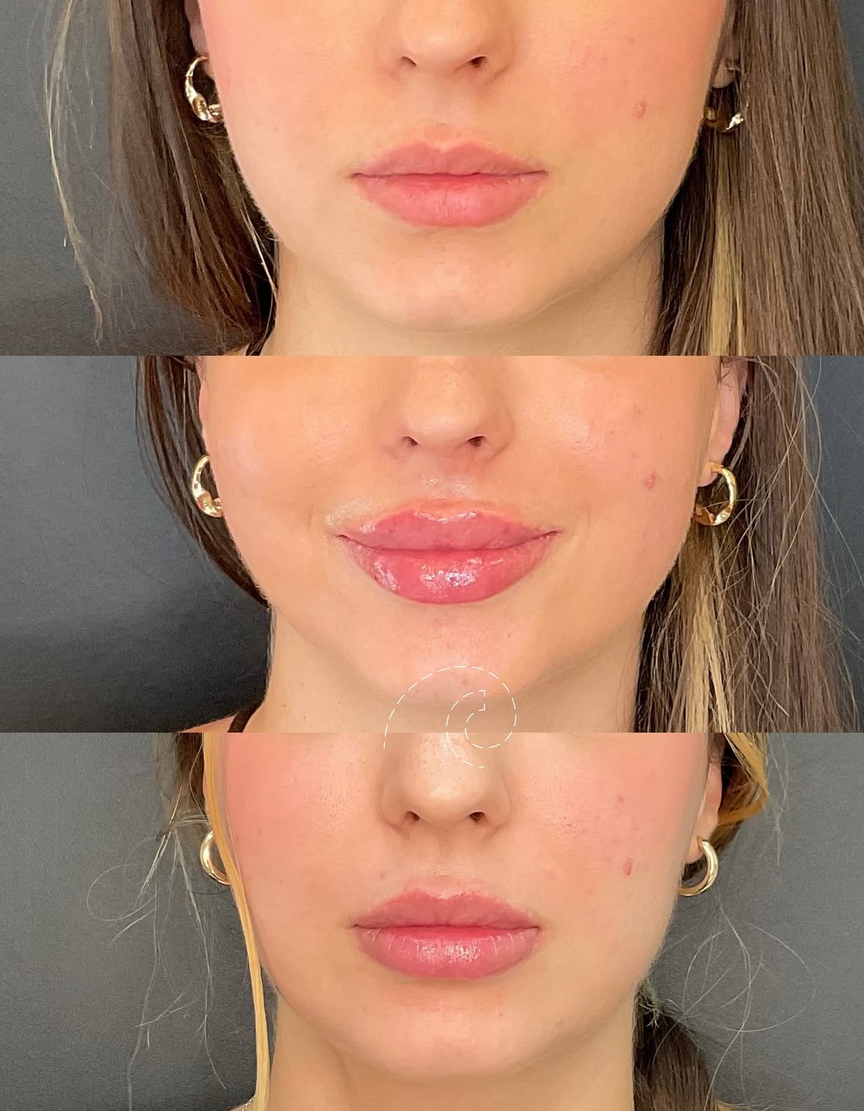 aumento labios Madrid Cliniem