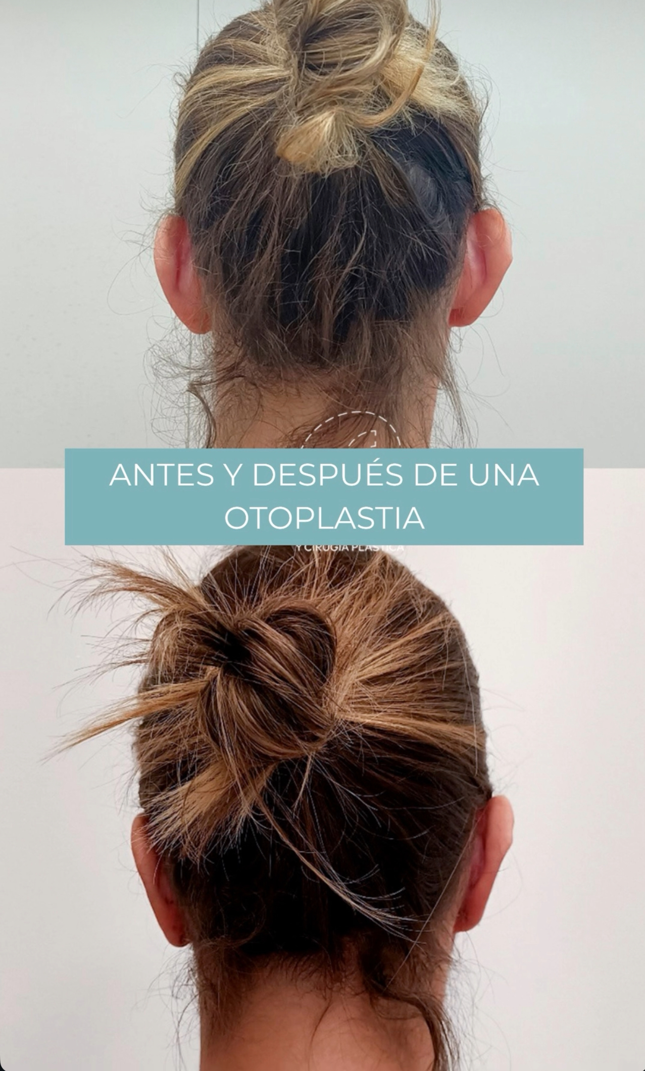 otoplastia cirugía orejas Madrid Cliniem
