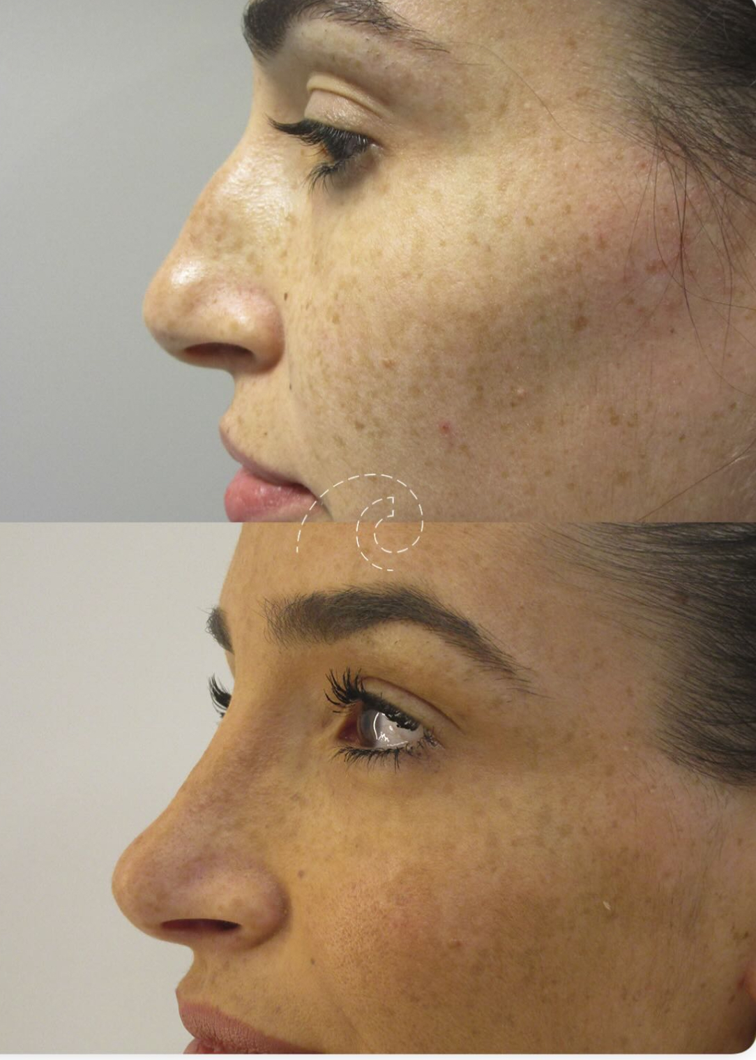 rinoplastia Madrid Cliniem