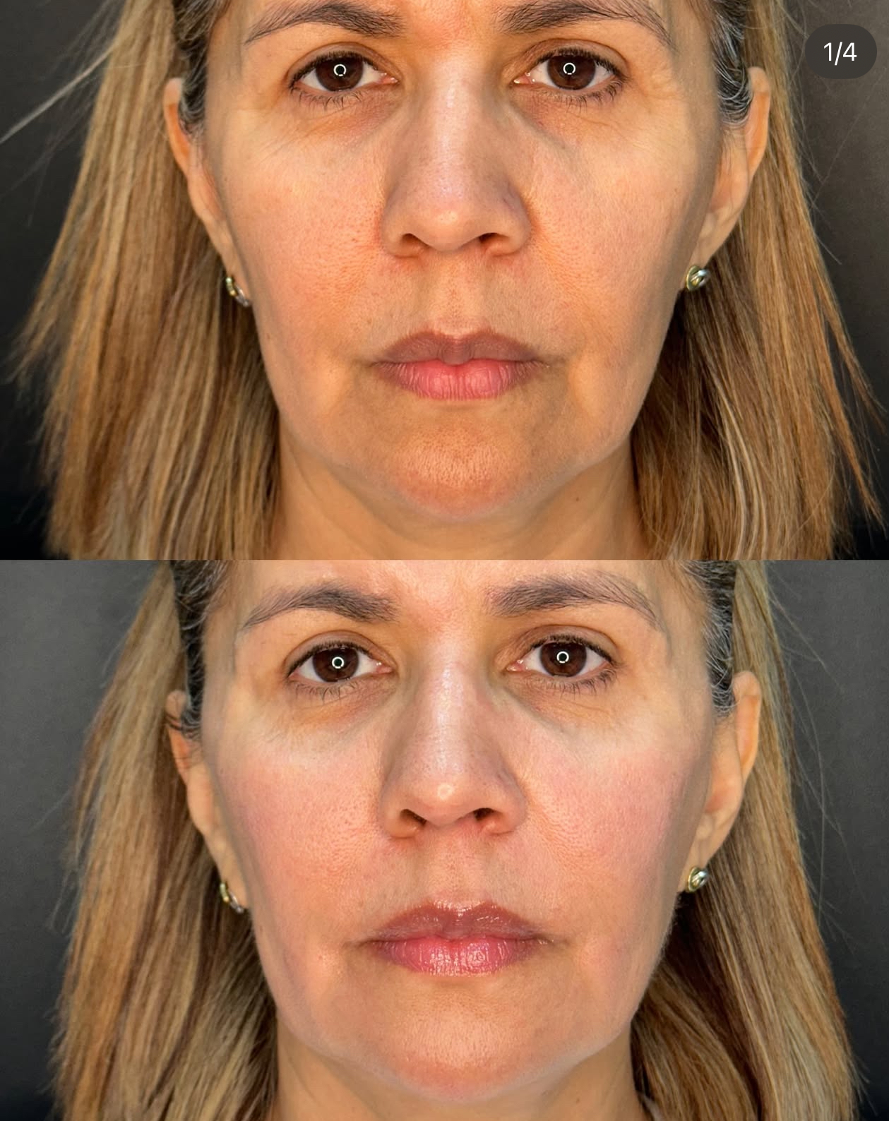 full face armonización facial Madrid Cliniem