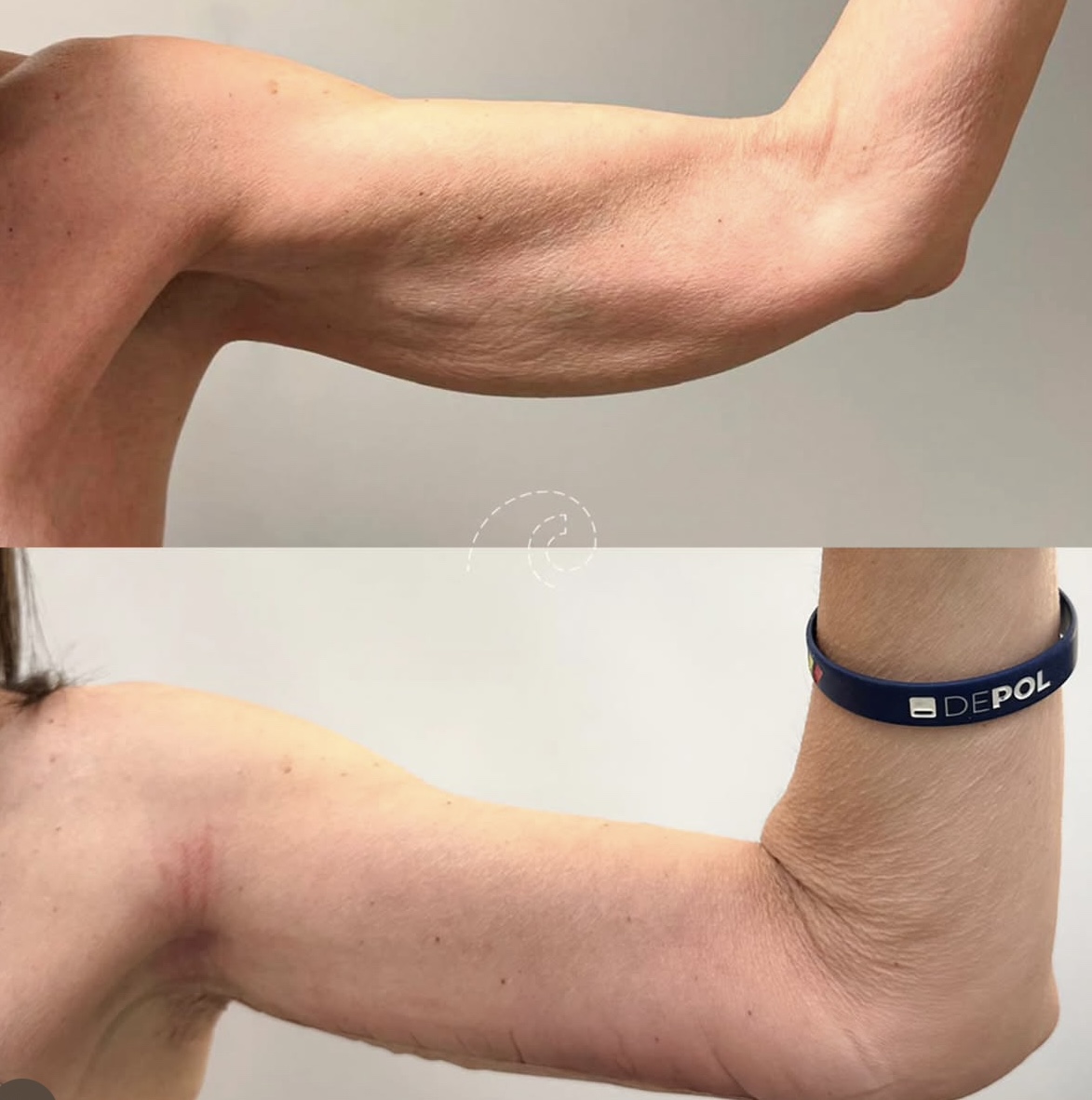 eliminar piel brazos Madrid Cliniem braquioplastia