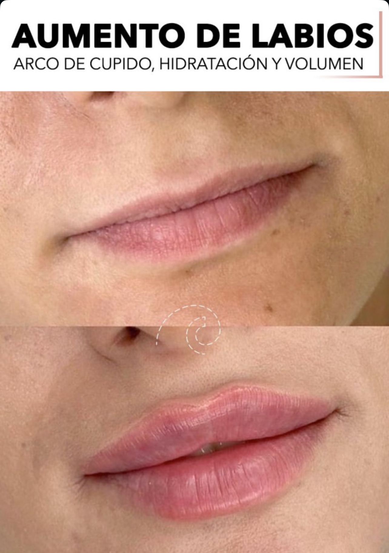 aumento labios Madrid Cliniem
