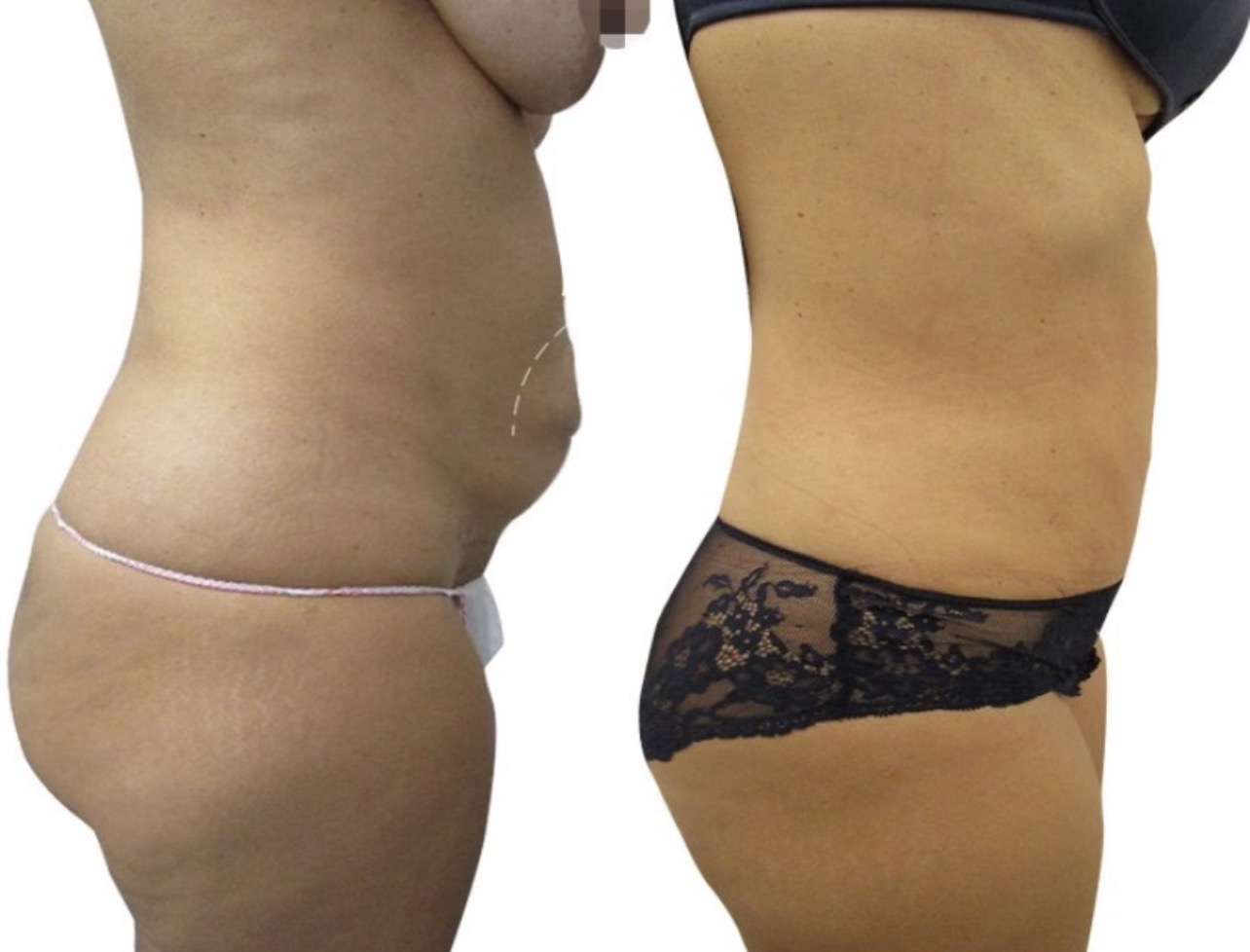 corrección diástasis Madrid Cliniem