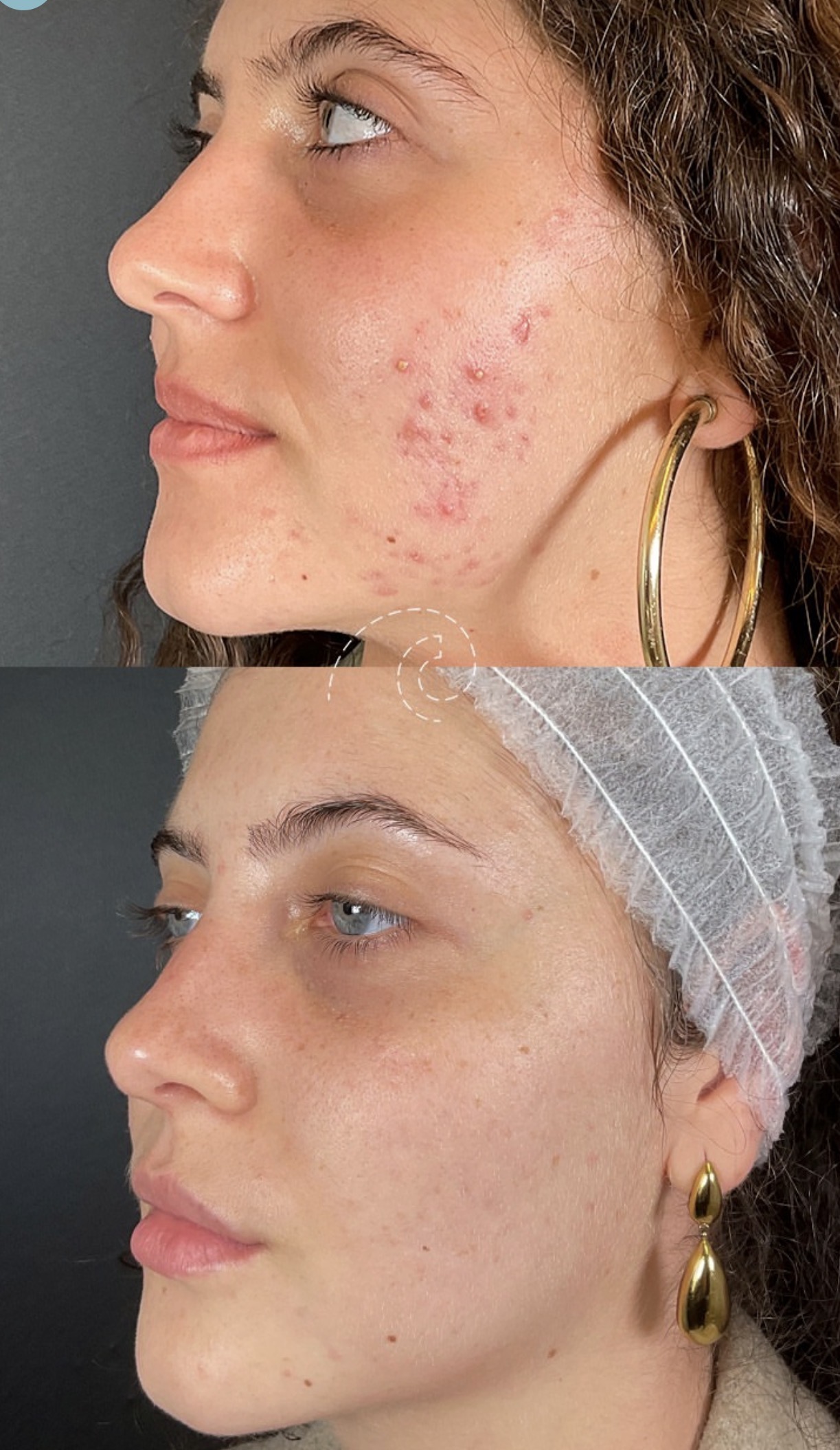 Eliminar cicatrices acné Madrid Cliniem