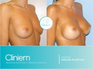 aumento pecho sin dolor Preservé Madrid Cliniem