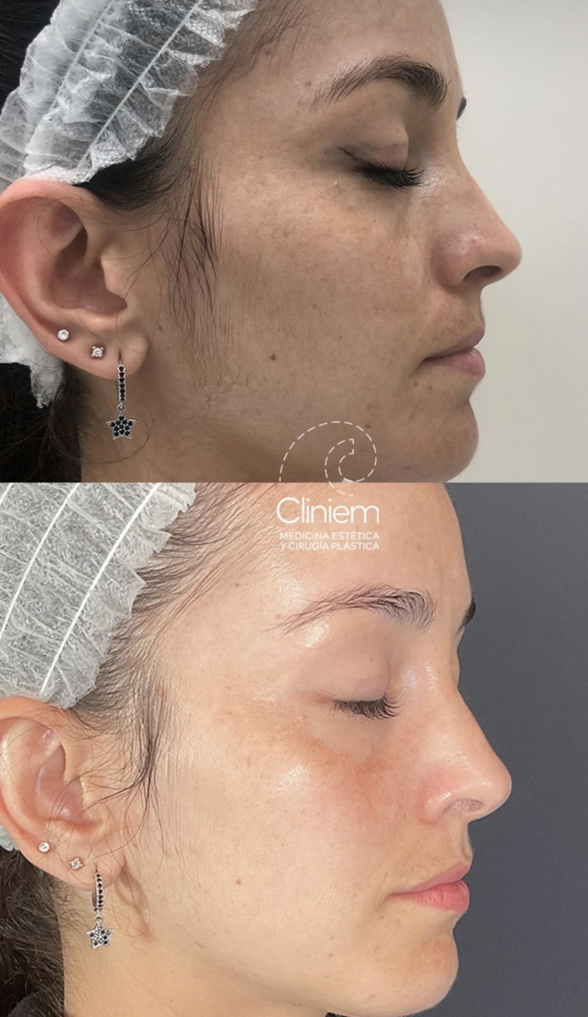 melasma eliminar manchas Madrid Cliniem