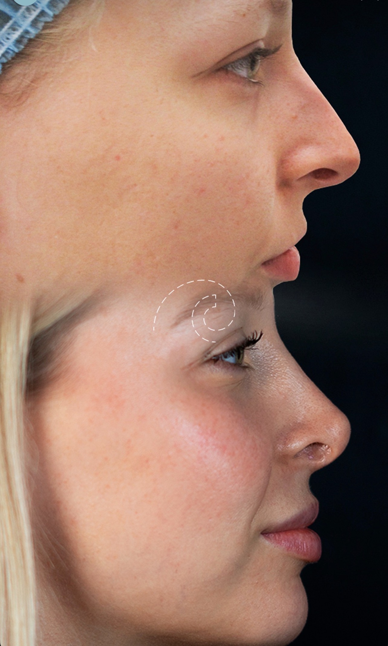 rinoplastia Madrid Cliniem