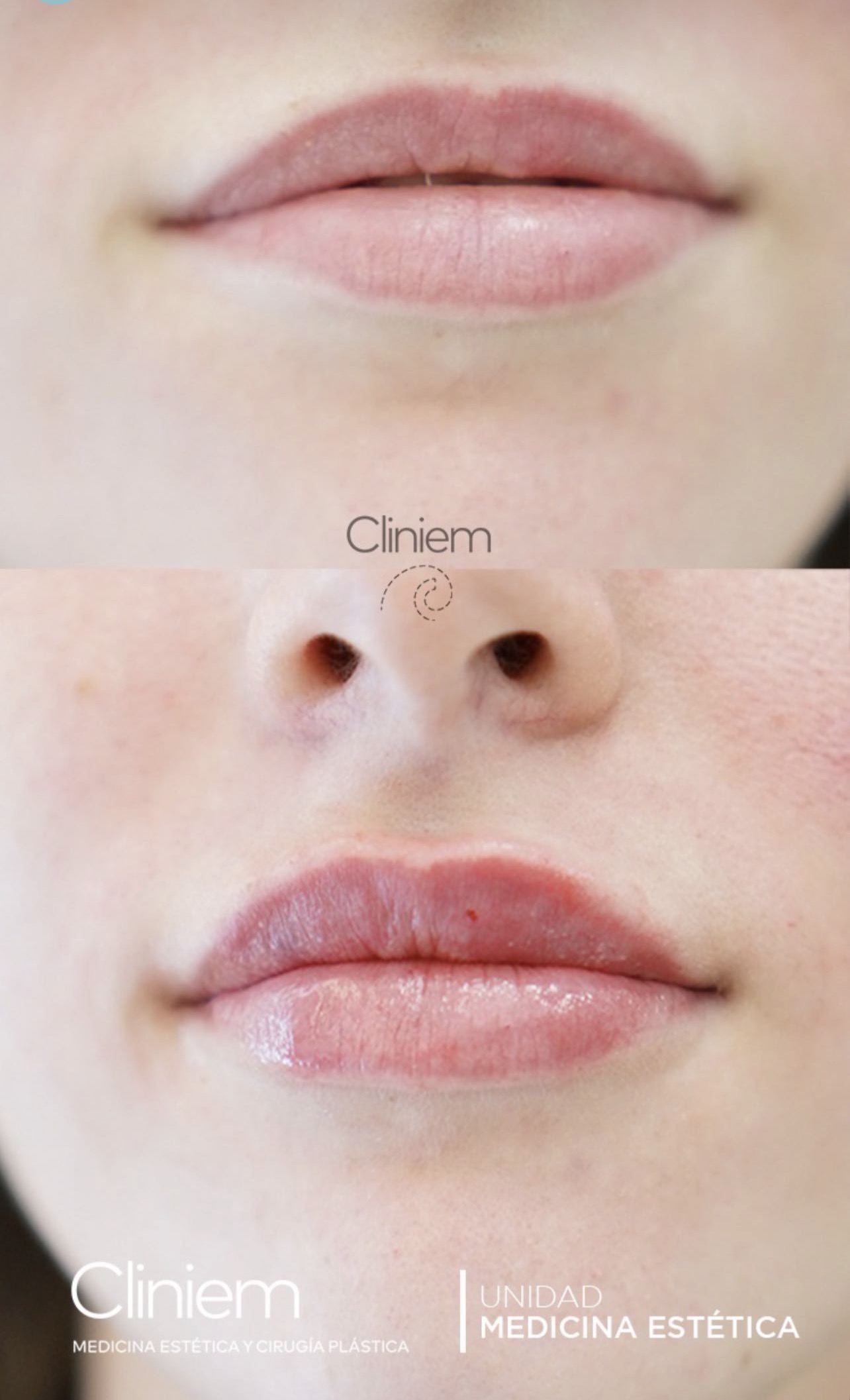 ¿Buscas un aumento de labios en Madrid con un resultado natural y elegante?