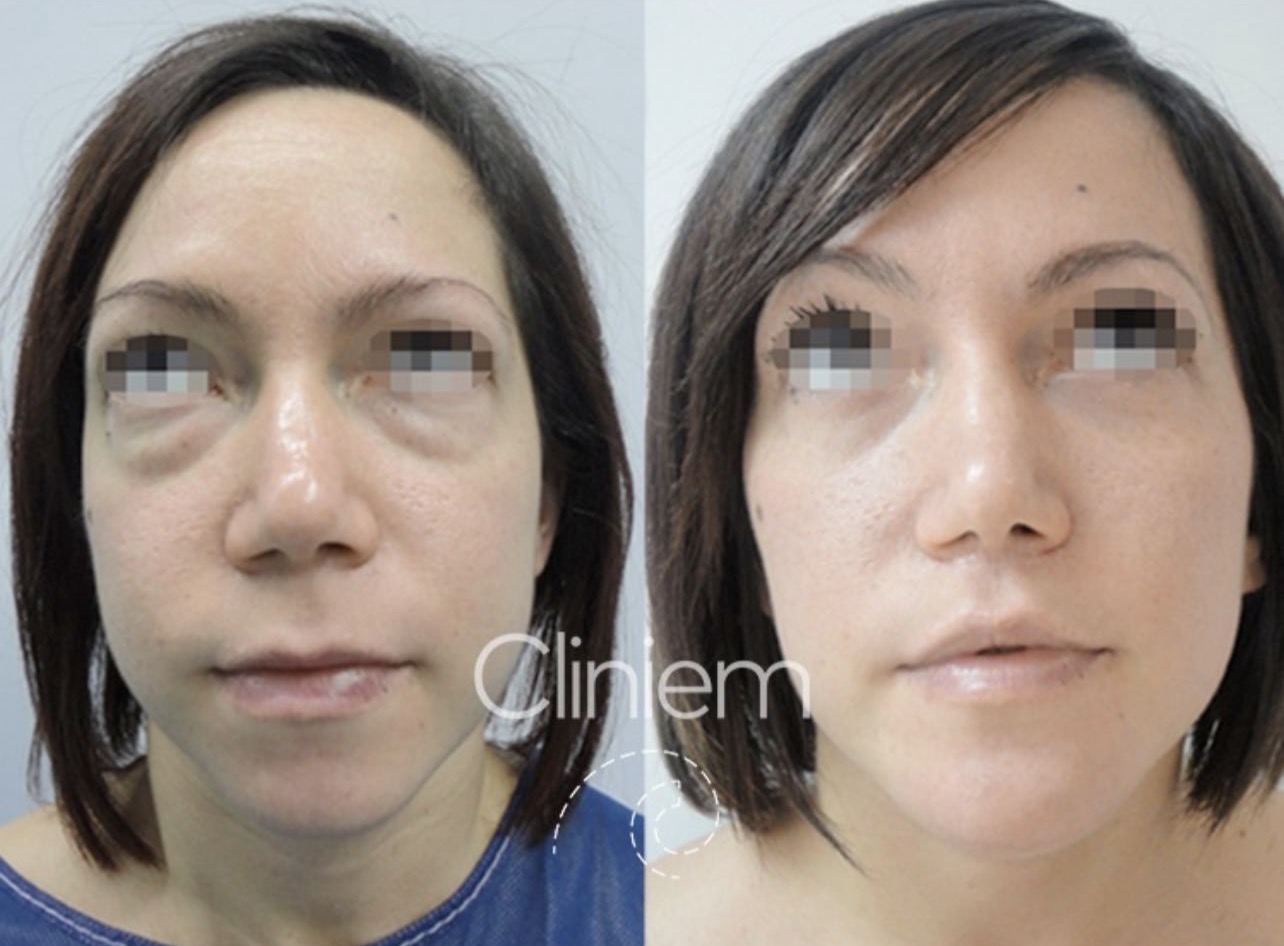 blefaroplastia MAdrid Cliniem