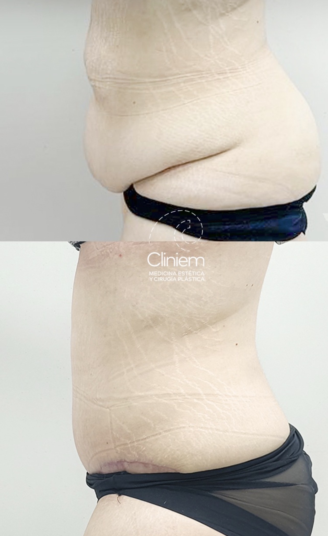 Liposucción y Abdominoplastia Madrid Cliniem