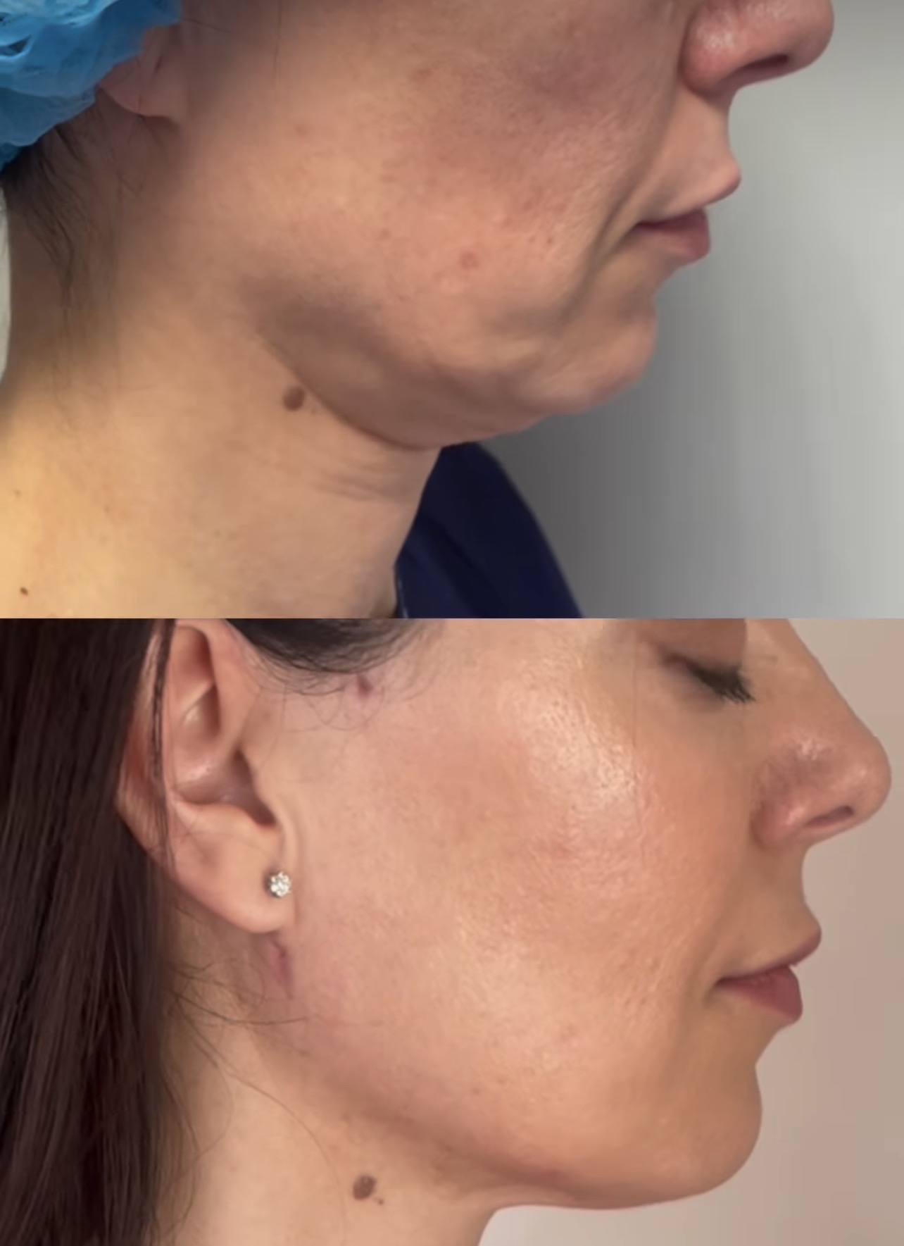 lifting Madrid Cliniem