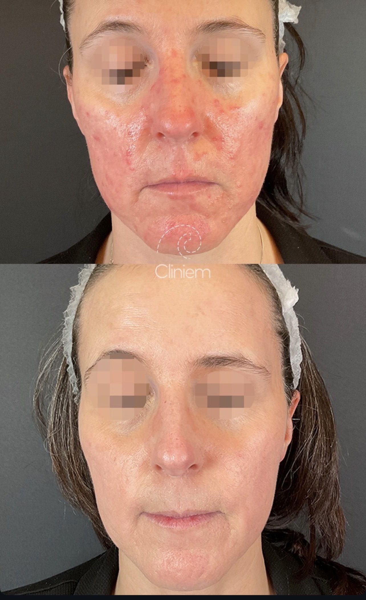 tratamientos rosácea Madrid Cliniem