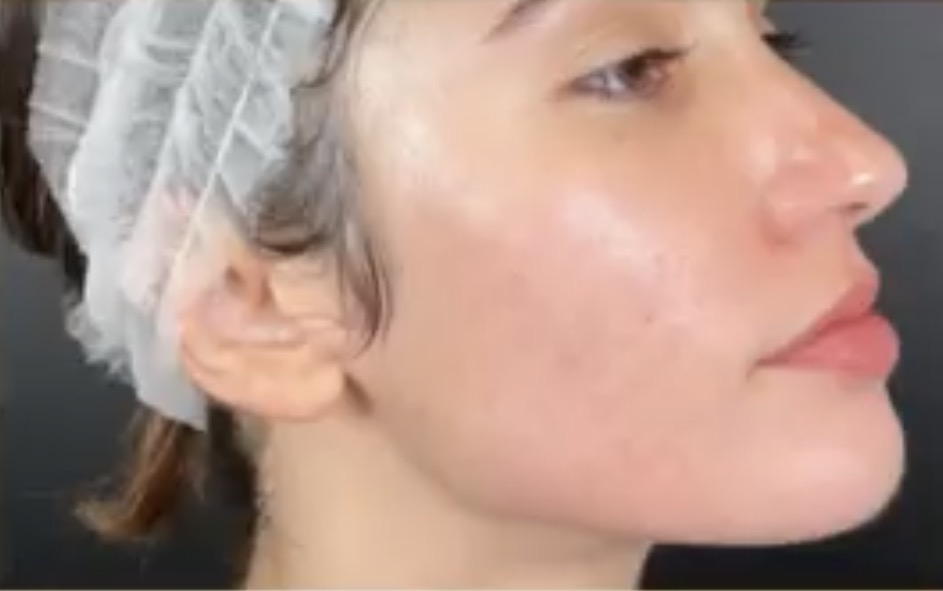 Acné quístico hormonal en adultos, cómo eliminarlo de forma rápida y efectiva