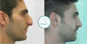 La importancia del postoperatorio en una rinoplastia