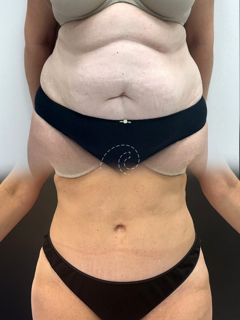 ABDOMINOPLASTIA