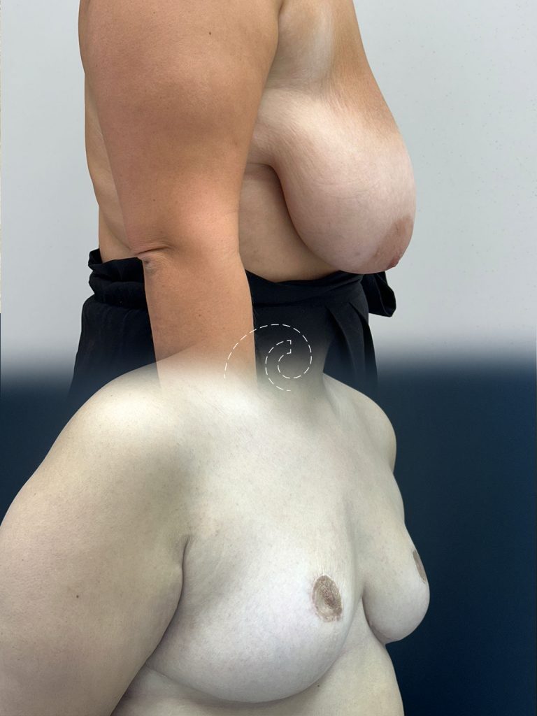 Reducción de Pecho