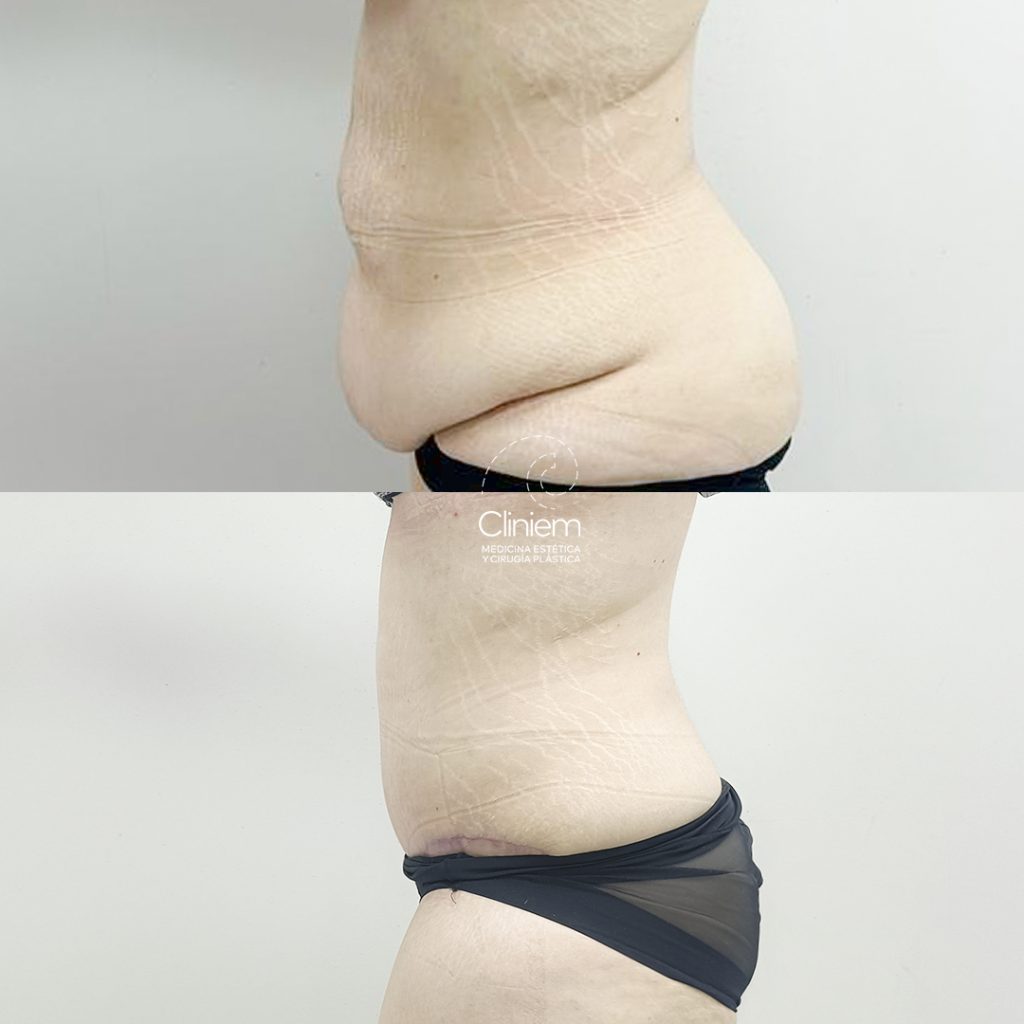 ABDOMINOPLASTIA