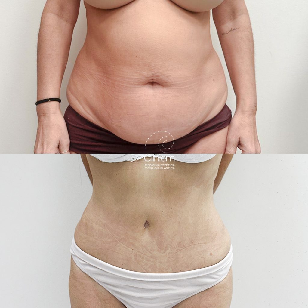 abdominoplastia y liposucción Madrid Cliniem