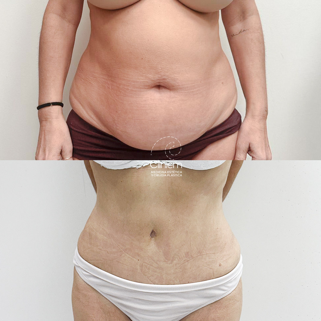 abdominoplastia y liposucción Madrid Cliniem
