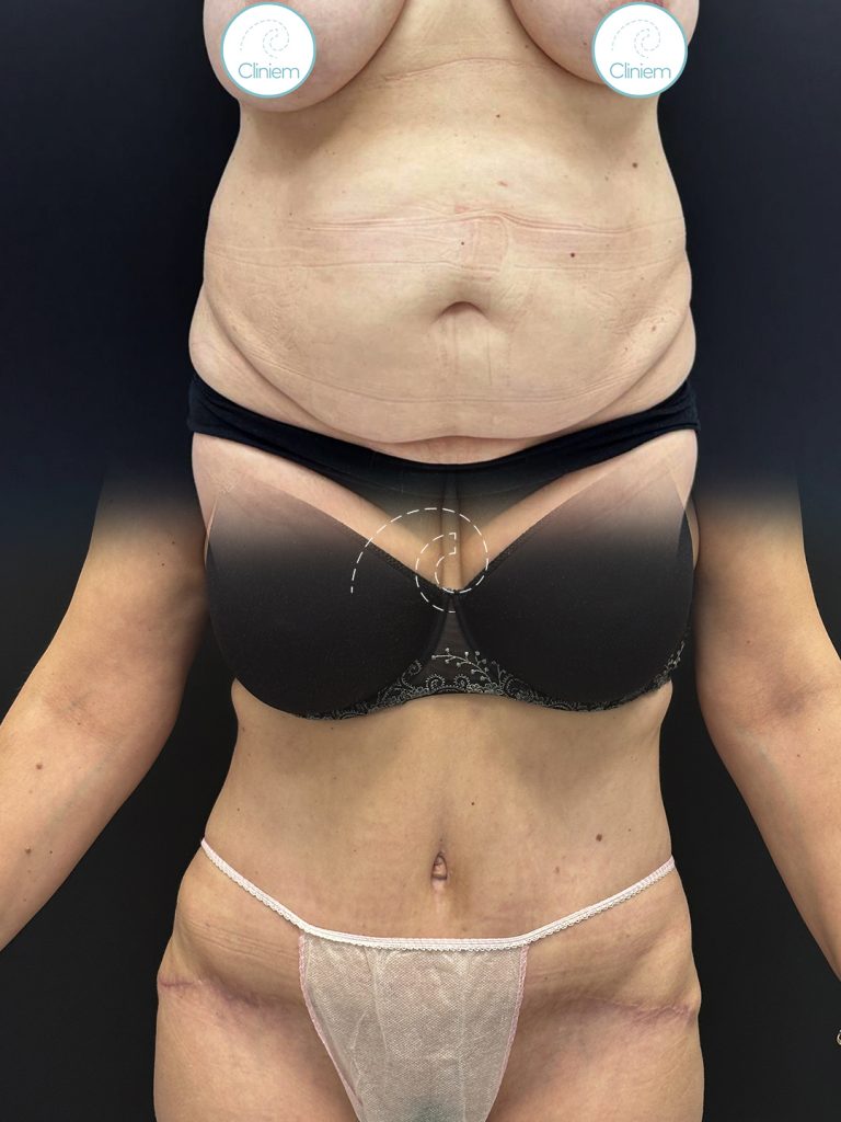 ABDOMINOPLASTIA