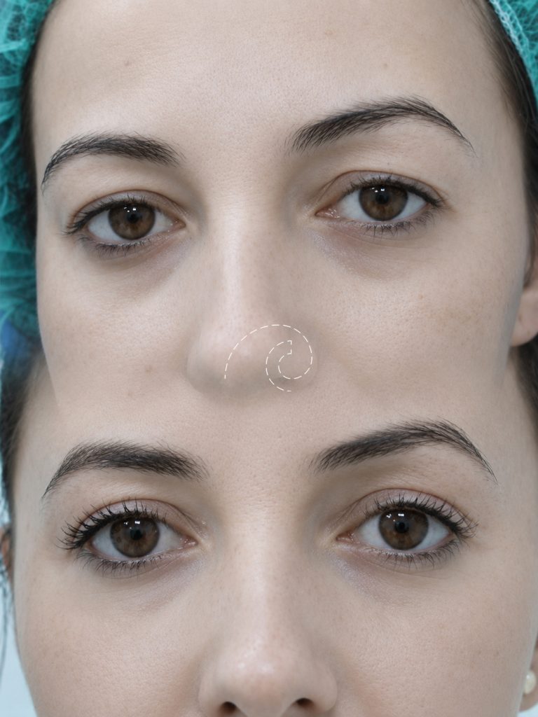 Blefaroplastia superior con láser