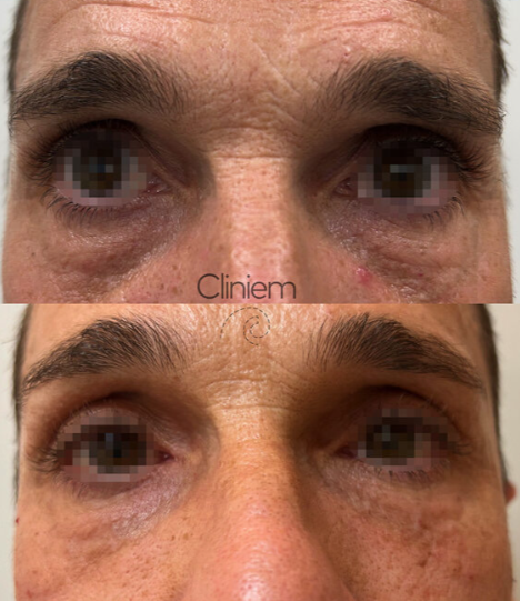 Ácido hialurónico para ojeras: tratamiento efectivo para rejuvenecer tu mirada