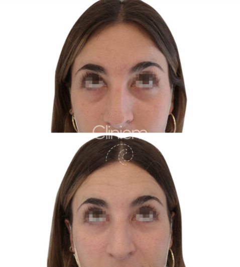 Ácido hialurónico para ojeras: tratamiento efectivo para rejuvenecer tu mirada
