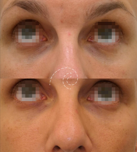 Ácido hialurónico para ojeras: tratamiento efectivo para rejuvenecer tu mirada