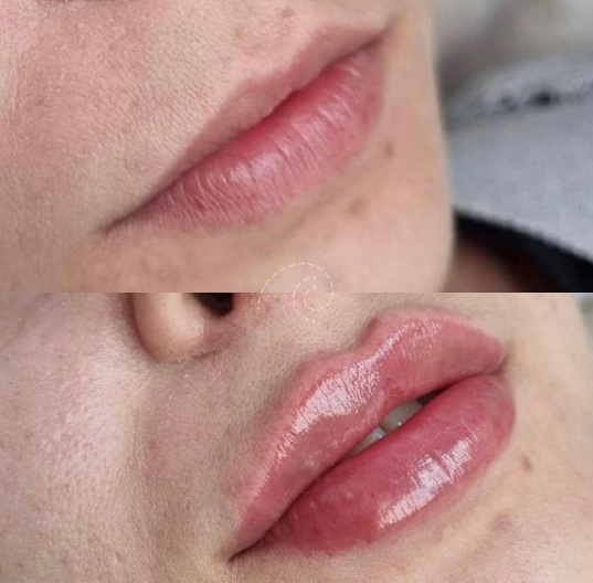 AUMENTO DE LABIOS