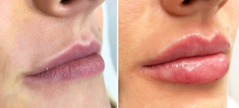 AUMENTO DE LABIOS