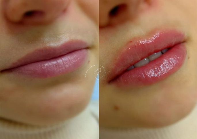 AUMENTO DE LABIOS